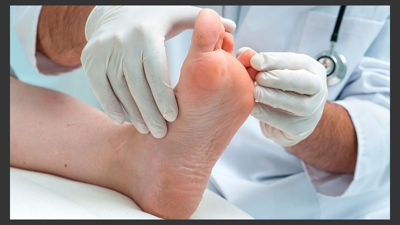 La neuropatía de los pies combinada con la reducción del flujo sanguíneo incrementan el riesgo de úlceras de los pies, infección y, en última instancia, amputación.