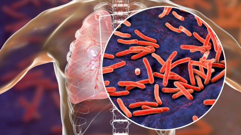 Esta enfermedad infecciosa causada por la bacteria Mycobacterium tuberculosis.